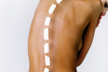 סקוליוזיס – עקמת בעמוד השדרה